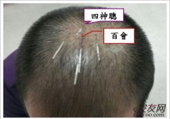 针灸对脱发治疗效果怎么样？
