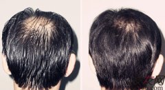 化学性脱发和脂溢性脱发的区别有哪些