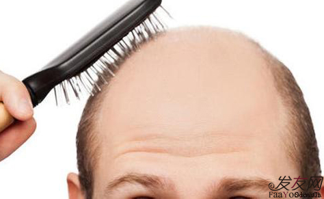 治疗男性严重脱发的方法有哪些？文章图片展示
