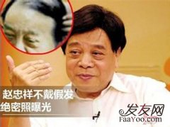 人为什么会患上鬼剃头？