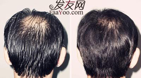 男性患上脂溢性脱发后该如何生发呢?