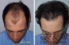 关于男性脱发的偏方治疗