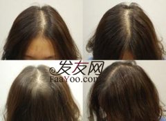 女性脱发与哪些因素息息相关