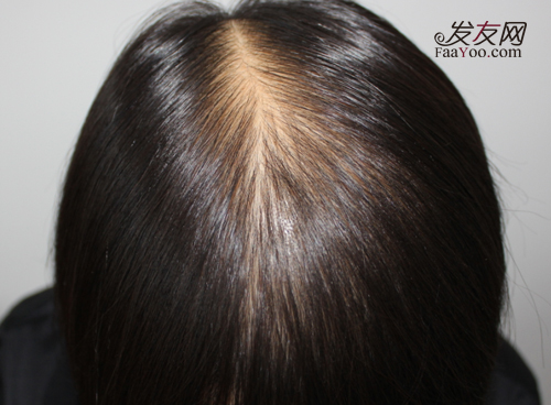 女性脱发偏方治疗有哪些 图片浏览