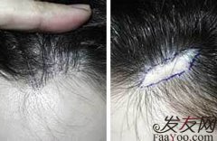 疤痕性脱发的治疗方法都有哪些