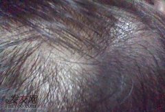 脂溢性脱发是什么情况引起的