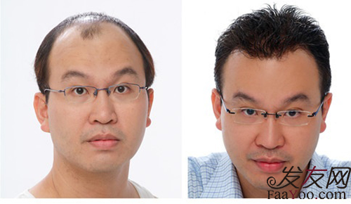脂溢性脱发怎么办,脂溢性脱发治疗偏方