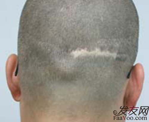 疤痕性脱发采用什么治疗方法比较好呢？