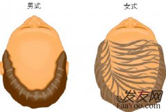 男人秃发是怎么回事,男人秃发是什么原因造成的