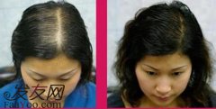 女性头发稀疏怎么办，女性头发稀疏采用什么方