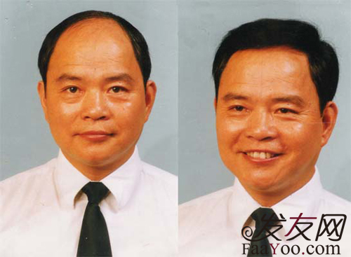 娱乐圈都有哪些明星做过织发补发