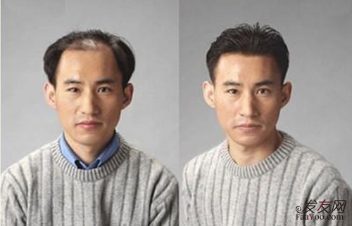 织发补发有什么危害吗,织发补发真的很安全吗