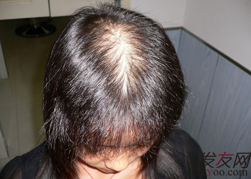 导致现代女性脱发的诱因有哪些?