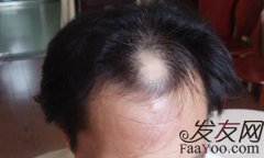 造成男性头发稀疏的原因是什么？