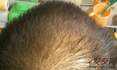 职业男人如何防止脱发情况发生?