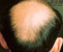 男性脱发有没有好的生发方法？