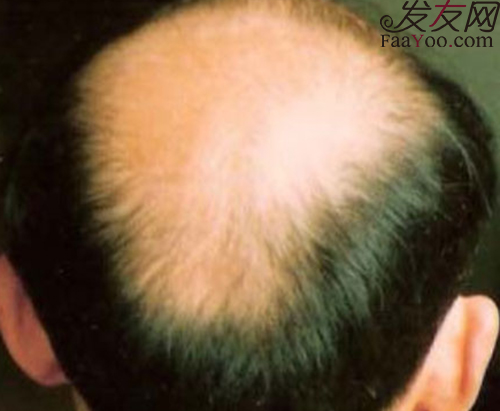 男性脱发有没有好的生发方法?