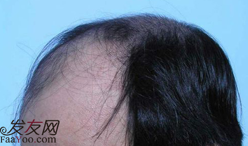 男性脂溢性脱发怎么治疗较好?