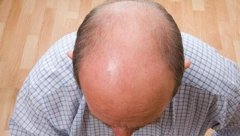 简述男性型脱发的疾病知识