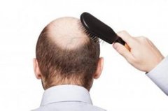 男子大量脱发是怎么回事，如何正确应对脱发？