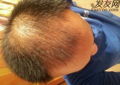 男性M型脱发怎么治疗比较好？