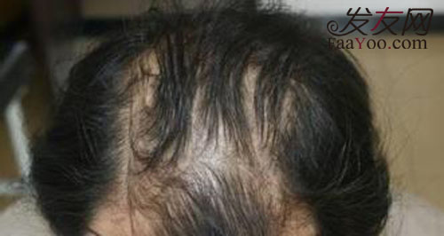 常见的造成脱发的原因有哪些？