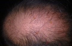 针对男性脂溢性脱发的最佳治疗方法是什么？