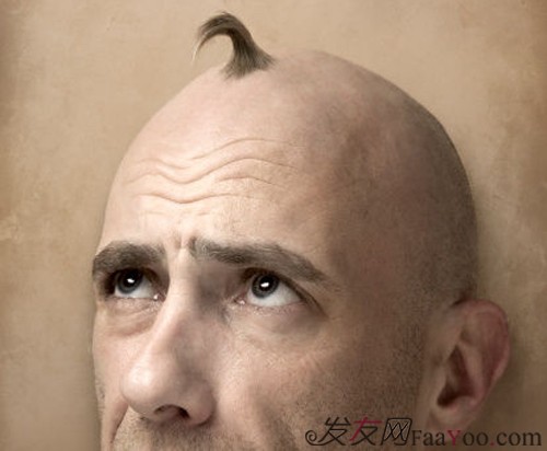 关于男性脱发严重的原因详解?
