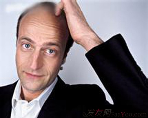 关于男性脱发的问题跟男性需了解的知识?