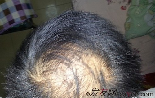 关于治男性脱发的偏方都有哪些?