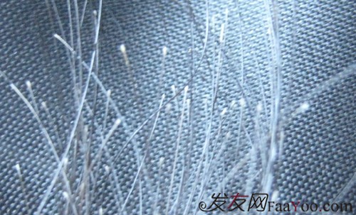 哪些原因能够引起斑秃脱发?