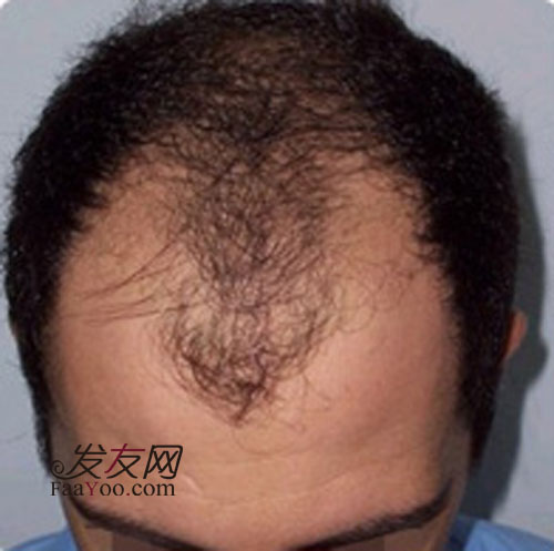 男性脱发治疗的方法都有哪些?