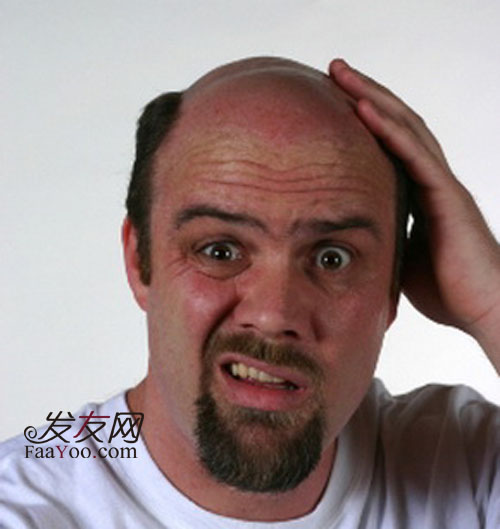治疗男性脱发的方法有些什么呢?