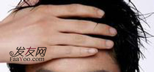 患有男性脱发使用什么方法治疗?