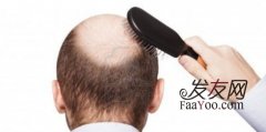 针对治疗男性脱发的方法都有哪些?