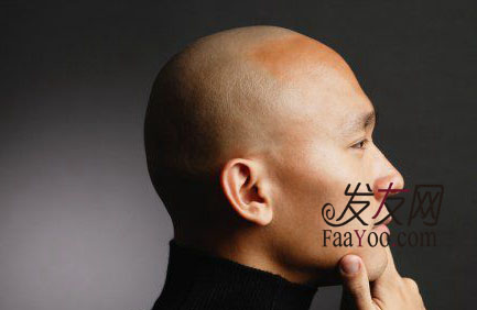 使用什么方法能够有效治疗男性脱发呢?