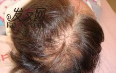 神经性脱发的原因跟治疗的方法都是什么？