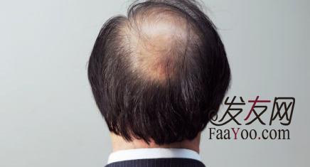 哪些方法可以治疗脱发呢？