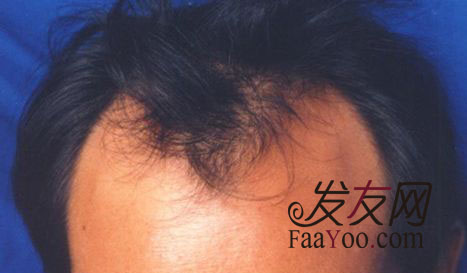 雄性脱发的治疗方法都有是什么?