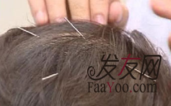 遗传性脱发有哪些治疗的方法?