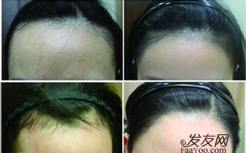 自体毛发移植手术危害大吗 