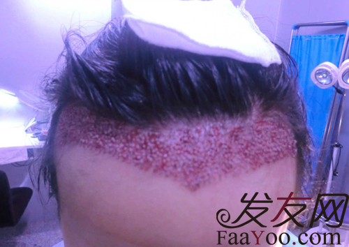 植发手术真的有副作用吗,影响身体健康吗?