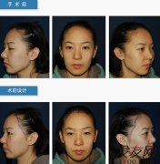 女性额头高做植发手术好不好,和男性植发一样吗