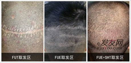 FUE植发技术好不好,植发效果真的有宣传的那么好 