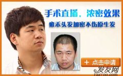 过早的植发好不好,什么时候做手术最为合适?