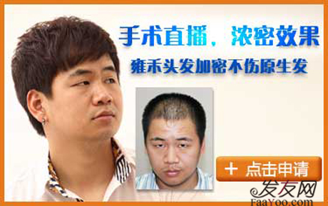 过早的植发好不好,什么时候做手术最为合适?