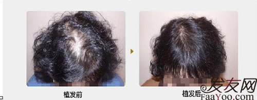 女性植发效果不如男性,这种情况是真的吗?