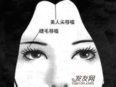 女性植发问题,种植美人尖后会留下疤痕吗？
