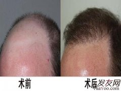 发友害怕植发究其原因是植发后遗症造成的