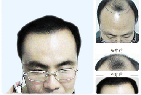 关于男性脱发植发的危害知识解说 